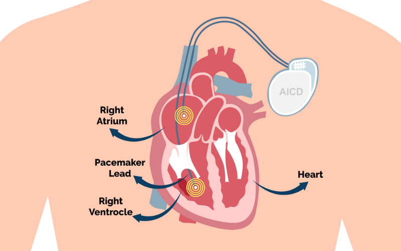 AICD Implantation