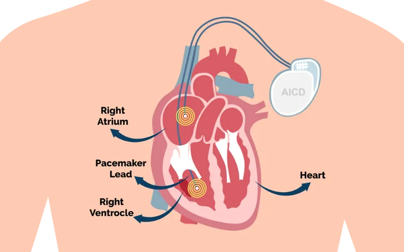AICD Implantation