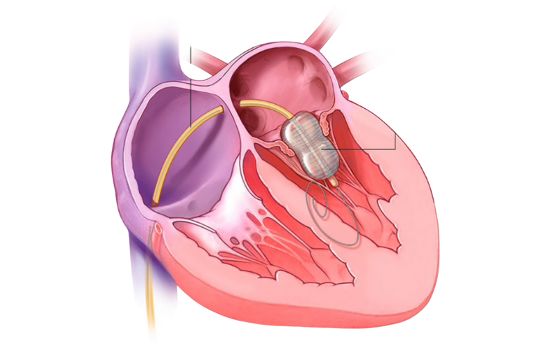Balloon Mitral Valvotomy