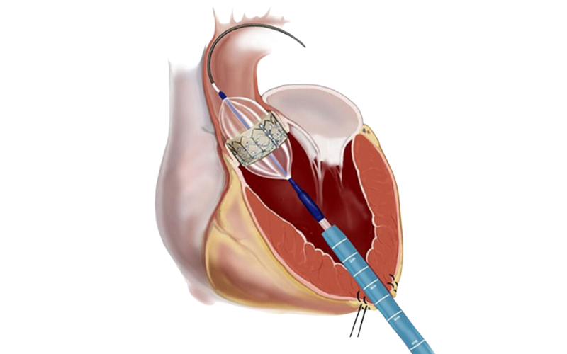 Balloon Pulmonary Valvotomy