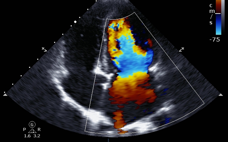 Color Doppler