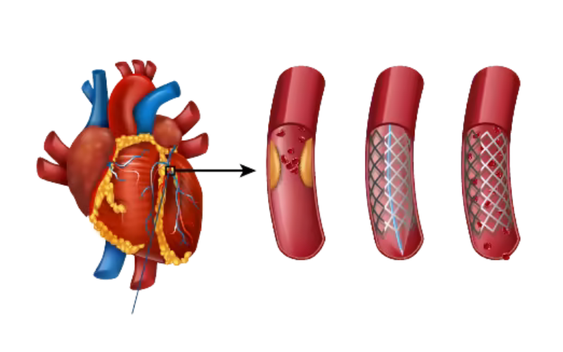 Coronary Angiography