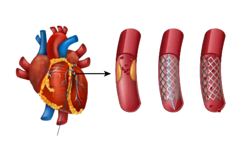 Coronary Angiography