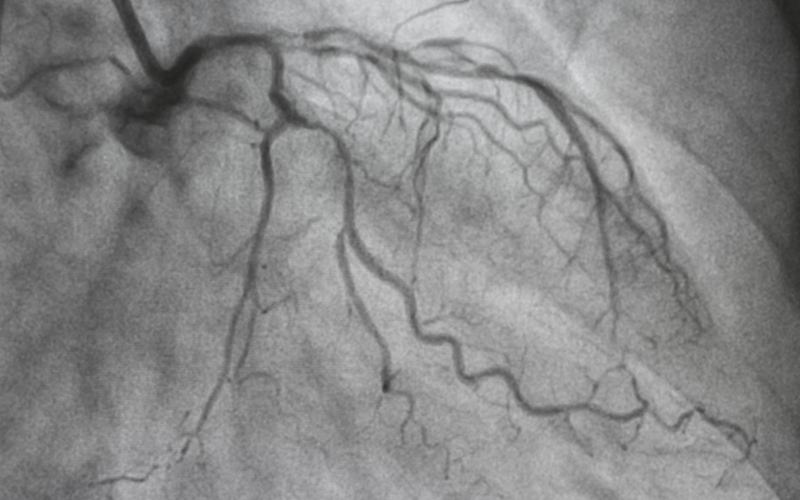 Coronary Angioplasty