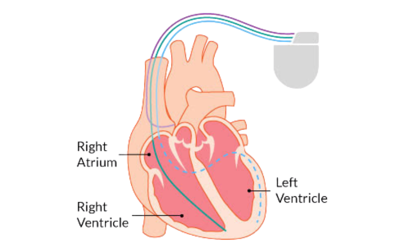 CRT-D Implantation