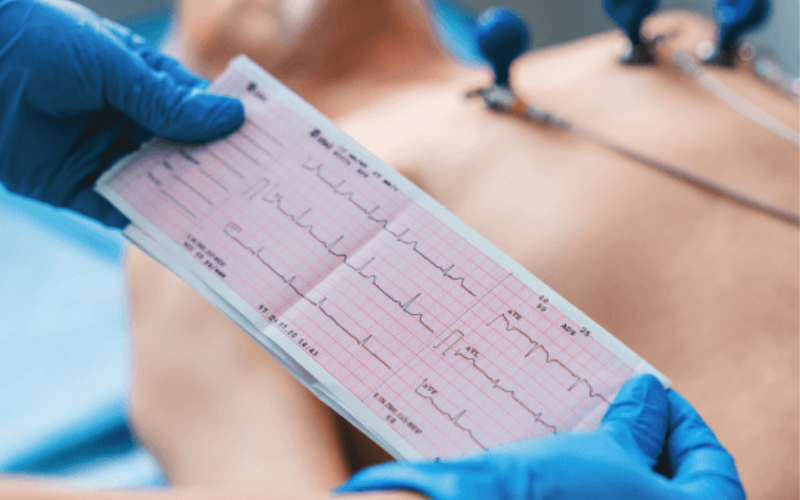 ECG