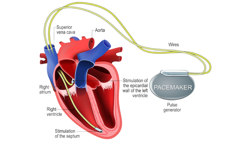 Pacemaker Implantation