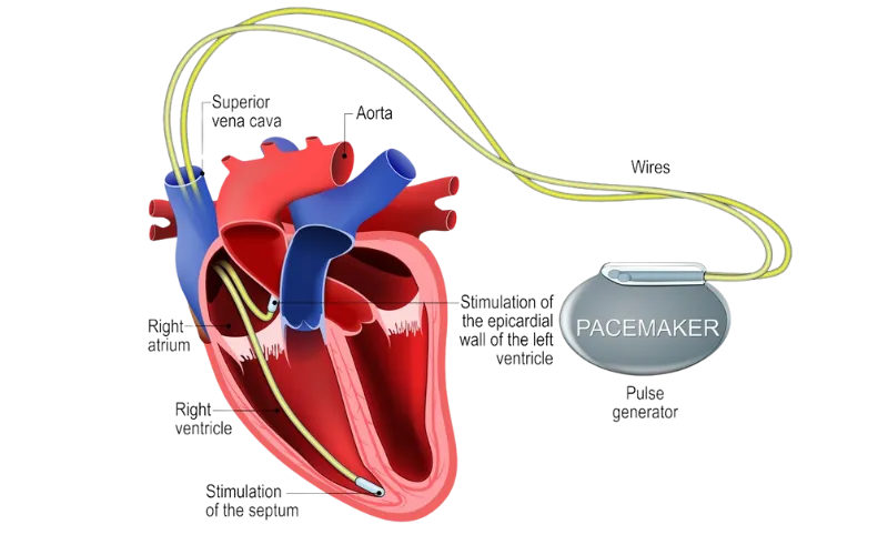 Pacemaker Implantation