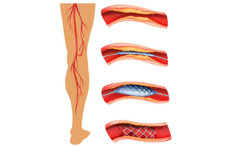 Peripheral Angioplasty